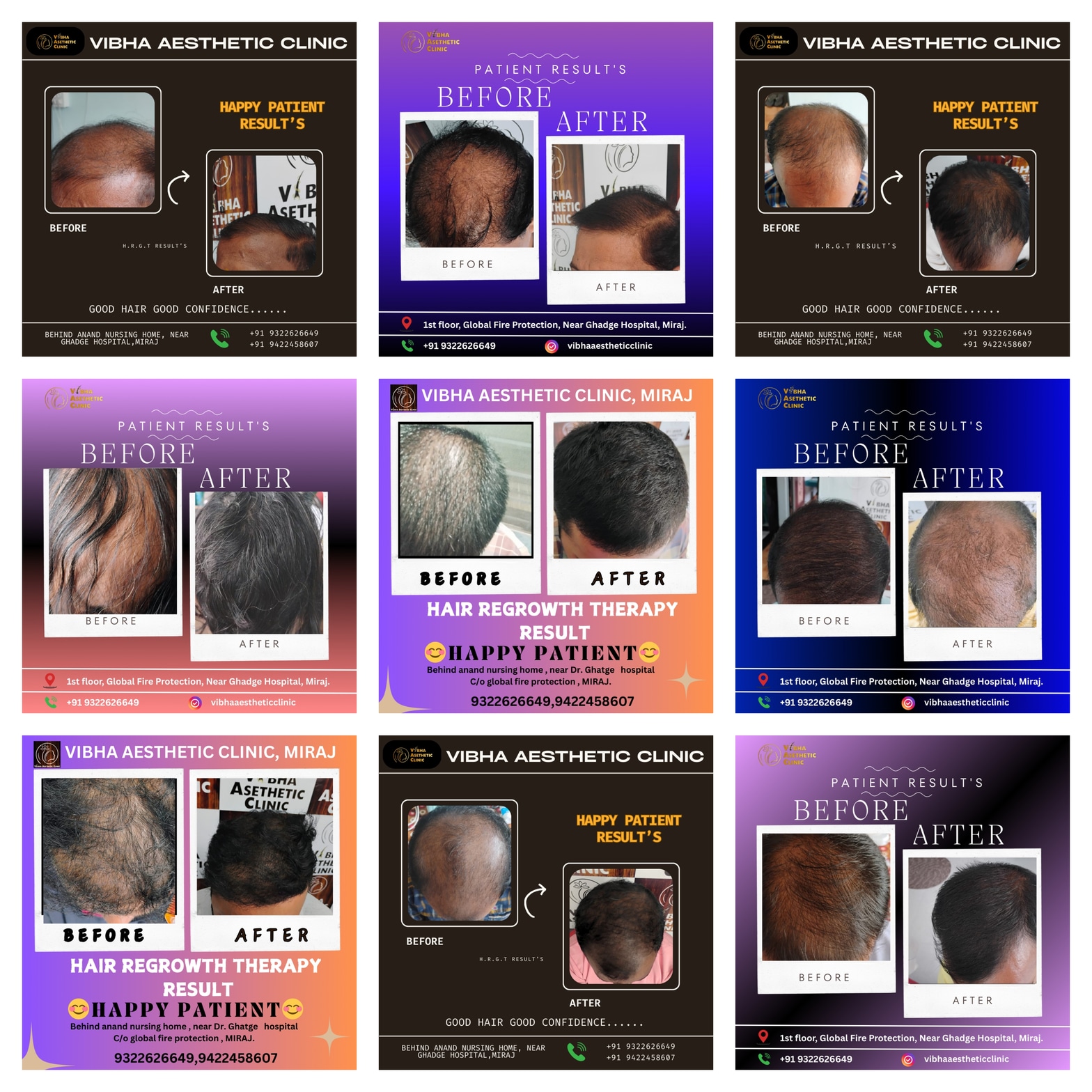 Hair Regrowth Results - Vibha Aesthetic Clinic
