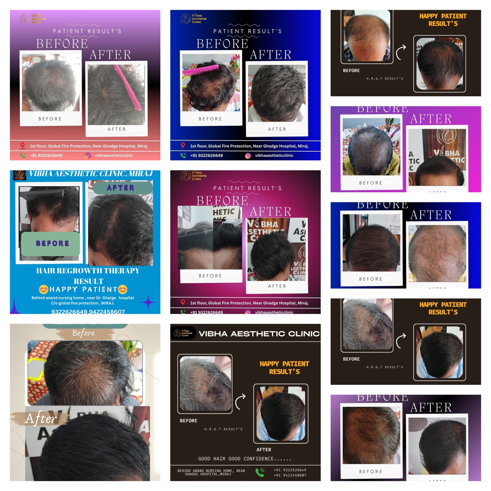 Hair Treatment Results - Vibha Aesthetic Clinic