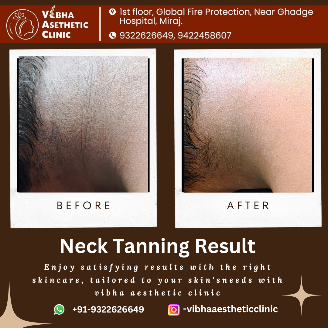 Medifacial Result - Vibha Aesthetic Clinic