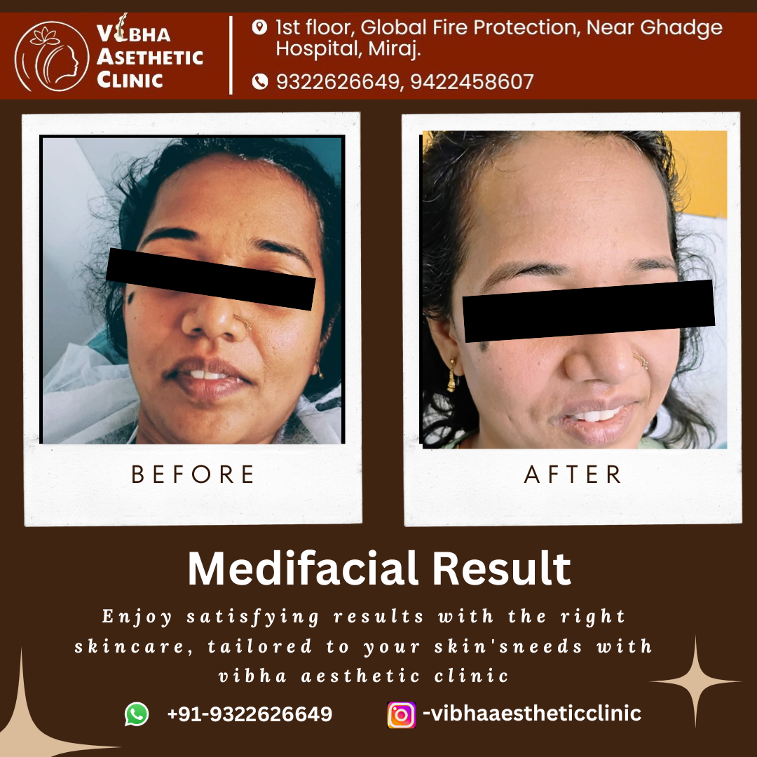 Pigmentation Treatment Result - Vibha Aesthetic Clinic