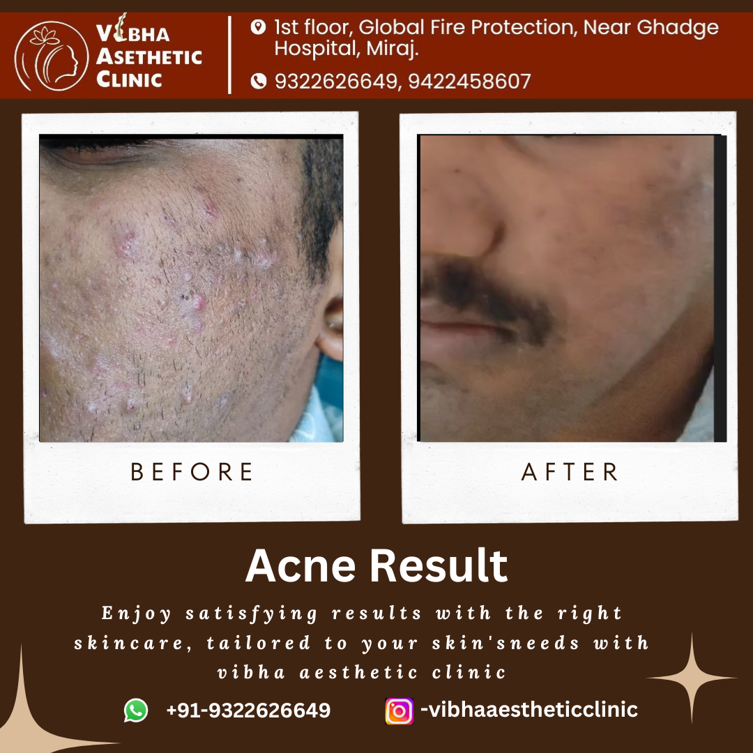 Skin Brightening Result - Vibha Aesthetic Clinic