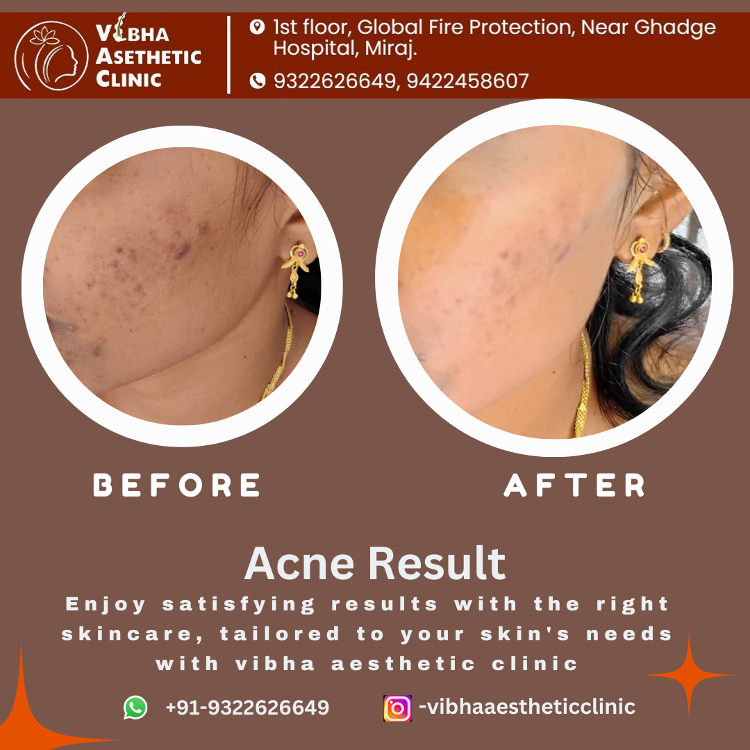 Acne Result - Vibha Aesthetic Clinic
