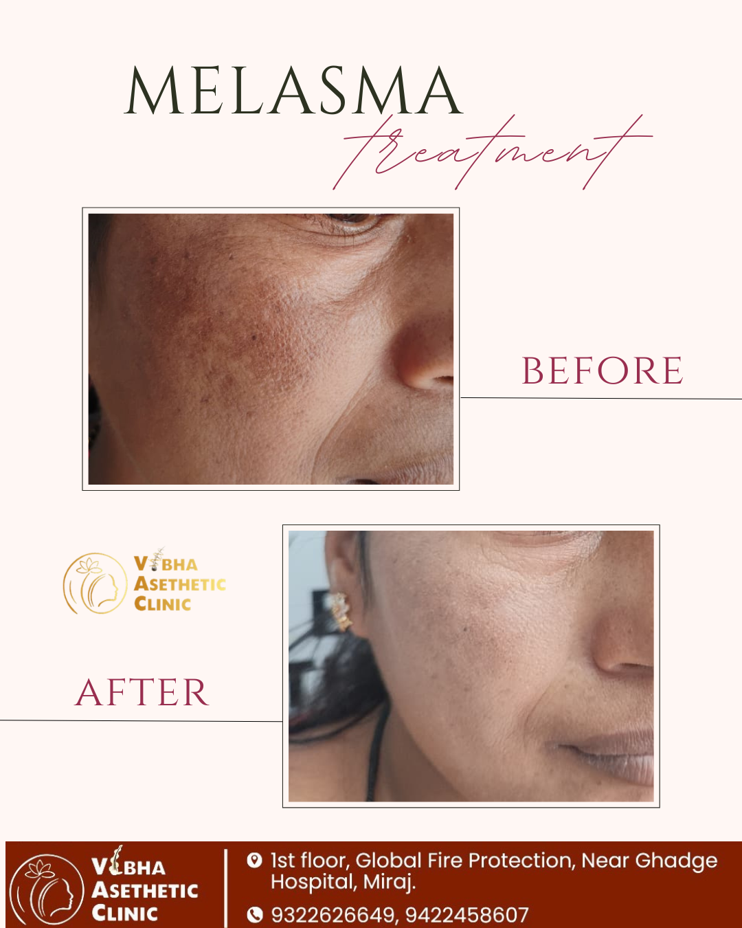 Brow Treatment Result - Vibha Aesthetic Clinic