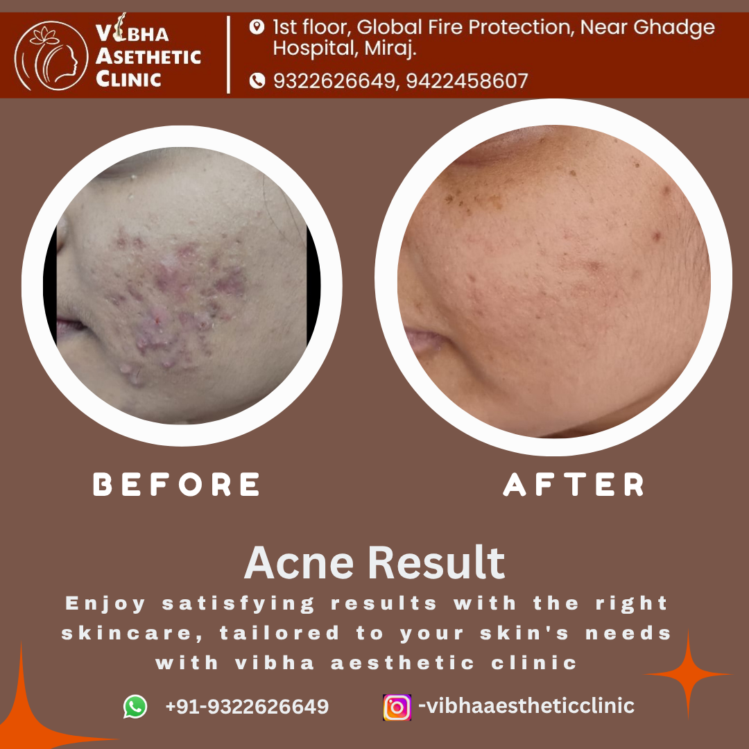 Acne Treatment Result - Vibha Aesthetic Clinic