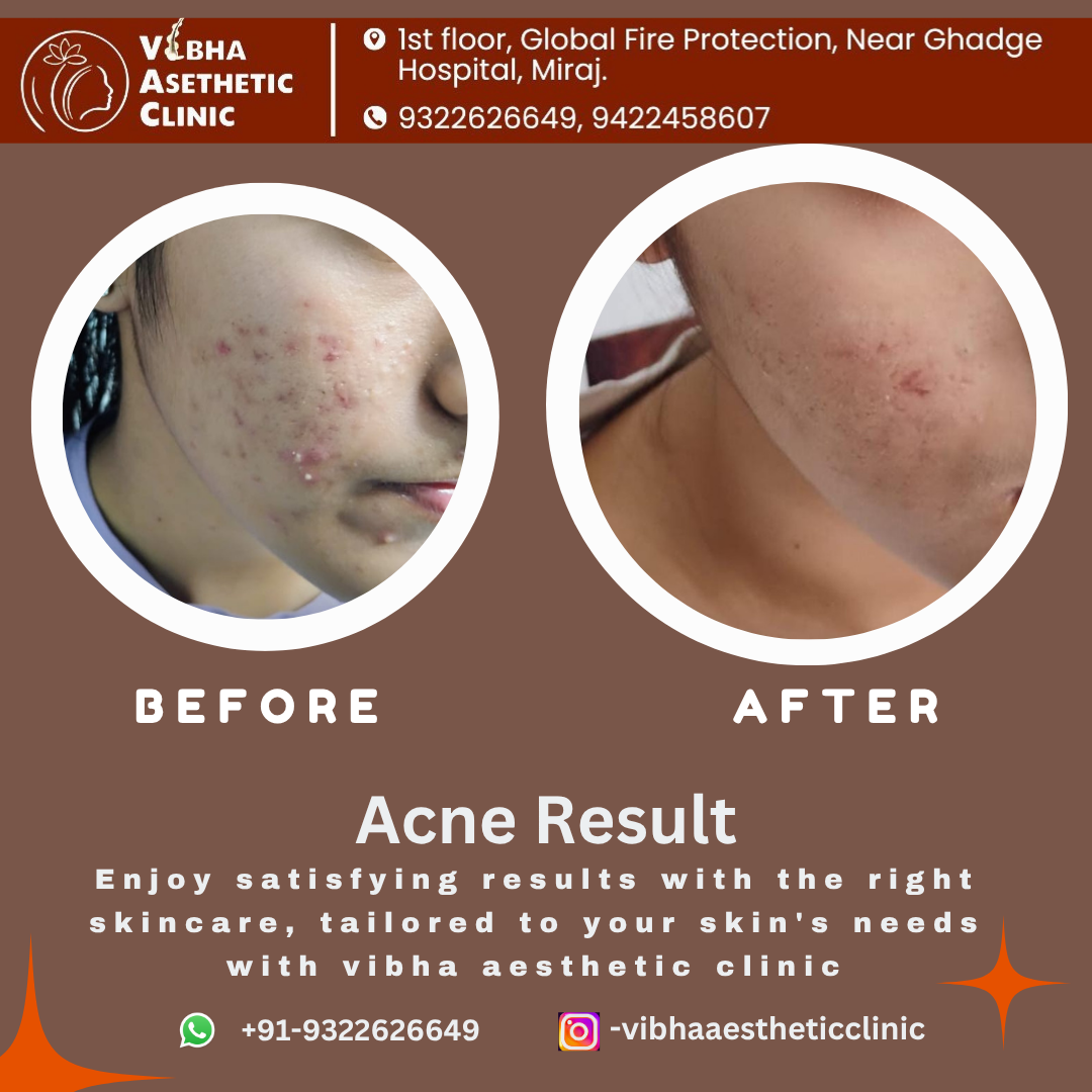 Acne Scar Treatment Result - Vibha Aesthetic Clinic