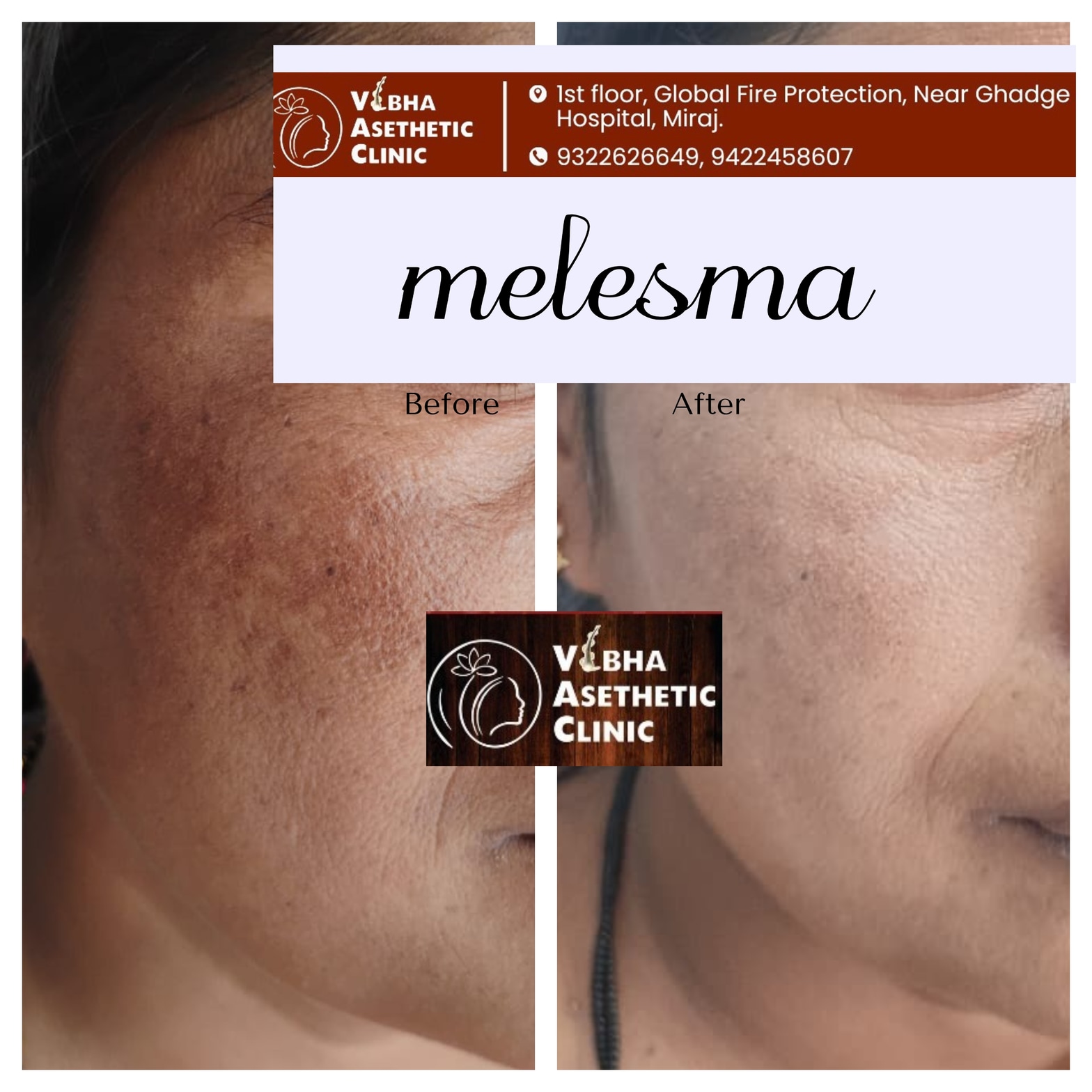 Melasma Treatment Result - Vibha Aesthetic Clinic